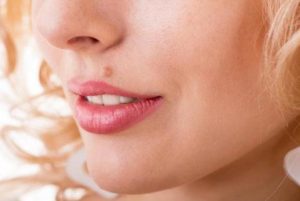 از بین بردن خال گوشتی با یک روش موثر گیاهی!!