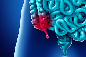 اگر آپاندیس پاره شود چه اتفاقی در بدن می افتد؟+ علائم آپاندیسیت