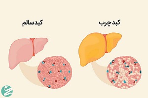 چطور کبد چرب اصولی درمان کنیم؟