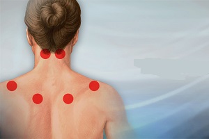 فیبرومیالژیا Fibromyalgia چیست؟ از علت تا درمان