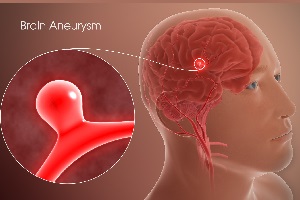 آنوریسم مغزی چیست و چقدر احتمال دارد به آن مبتلا شویم؟