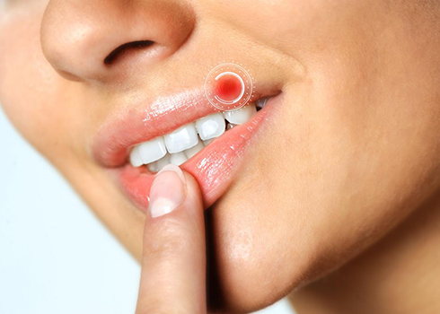  علت تبخال زدن چیست؟ + جلوگیری از تبخال