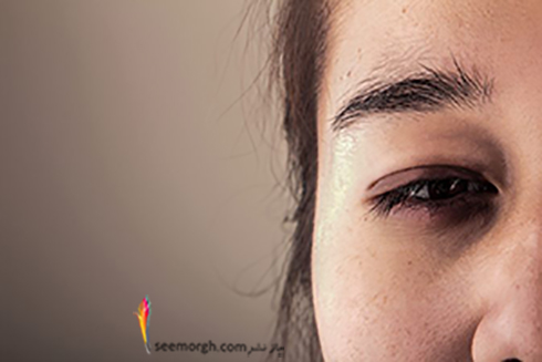 رفع پف چشم ها با یک رژیم غذایی مناسب رفع پف چشم ها با یک رژیم غذایی مناسب