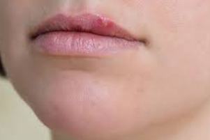 چگونه می توان از ابتلا به تبخال جلوگیری کرد؟