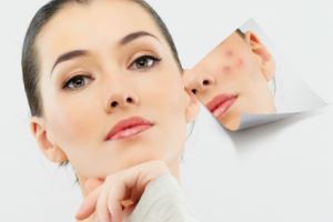 آکنه صورت تان را با این روشهای طبیعی بدون ضرر از بین ببرید