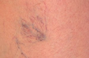 از واریس پیشگیری کنید